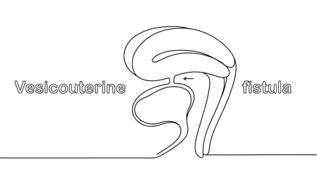 Vesicouterine fistula