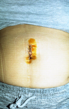 Post-Surgical Abdominal Wound