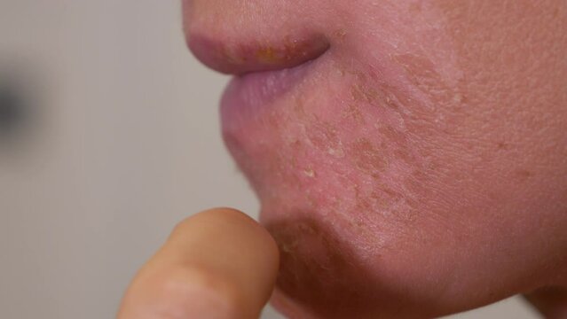 CLOSE UP, DOF: Lady with dermatitis scratches and peels of flaky skin from her face. Young woman with a damaged epidermis suffers from itchy and irritated red skin caused by an allergic reaction.