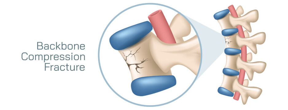 Backbone spinal cord compression fracture. Vertebra and compression or stress in the spinal cord. A type of broken bone that can cause your vertebrae to collapse, making them shorter.