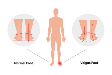 Normal and valgus Foot deformation 