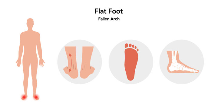 Flat Foot deformation 