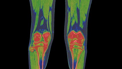  Healthy knee, CT scan bone