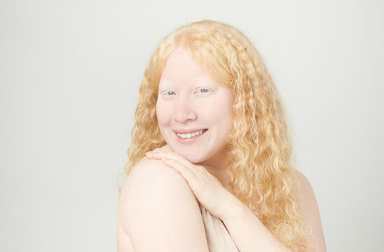 Albino girl