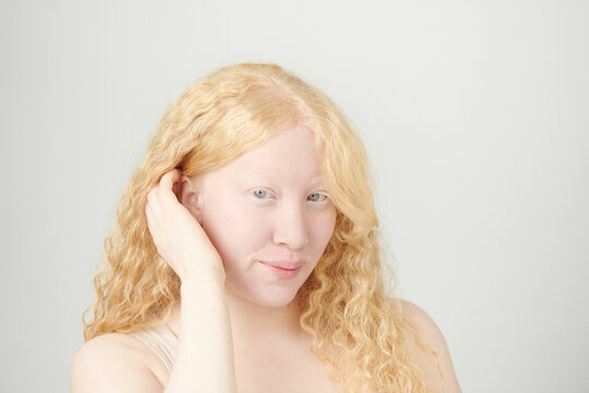 Albino girl