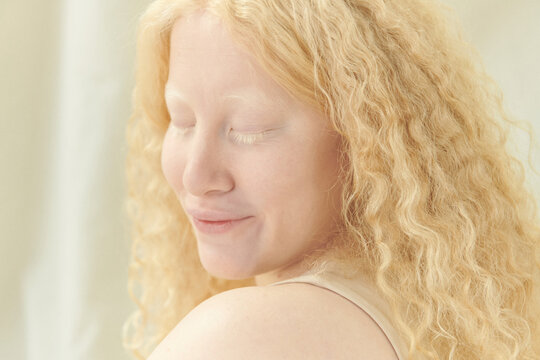 Albino girl