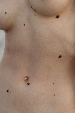 Detail-Close up photo of white skin texture with big moles on belly 