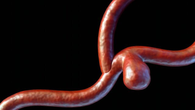 3d rendering of a saccular aneurysm, also known as a berry aneurysm, is a bulge that forms on the wall of a blood vessel in the brain
