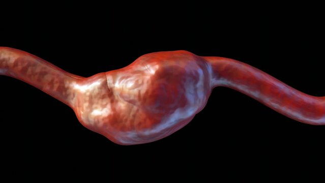 3d rendering of fusiform-shaped aneurysm bulges or balloons out on all sides of the blood vessel