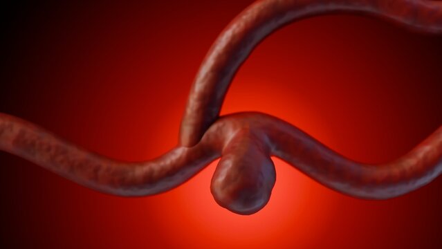 3d rendering of a saccular aneurysm, also known as a berry aneurysm, is a bulge that forms on the wall of a blood vessel in the brain
