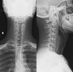 normal human cervical xray