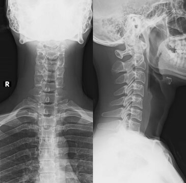 normal human cervical xray