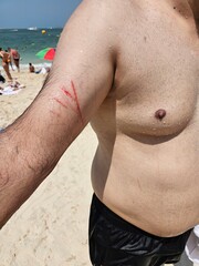 Emergency Response: Man's Injured Arm at Dubai JBR Beach