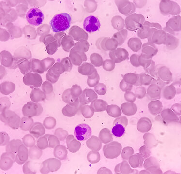 Bone marrow study (BMD). Myelodisplastic syndrome (MDS) or Refractory anemia. It's a group of cancers in which immature blood cells in the bone marrow. Myelodysplasia.