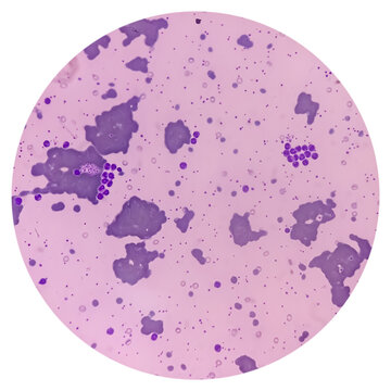 Cold agglutinins disease, RBCs to clump together (agglutinate) at low temperatures, autoimmune hemolytic anemia, anisocytosis anisochromia with macrocytes echinocytes seen. macrocytic anemia.
