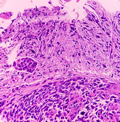 Larynx Cancer. Invasive squamous cell carcinoma. Section show malignant neoplasm.