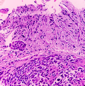 Larynx Cancer. Invasive squamous cell carcinoma. Section show malignant neoplasm.