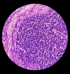 Inguinal lymph node (excised): Lymphoproliferative disorder (LPD). Section show lymph node.