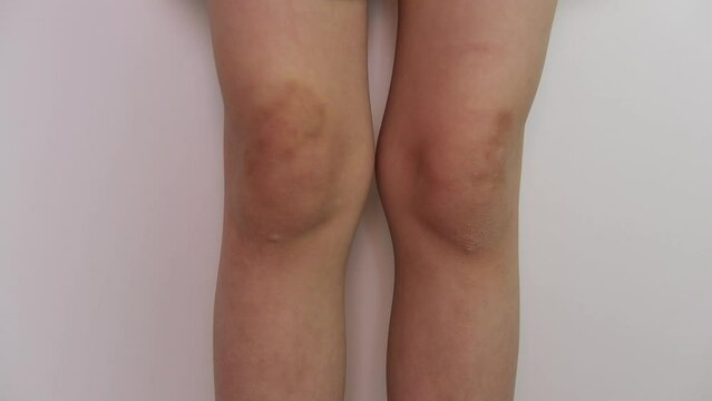 Close-up of children's knees with bruises bruises, scratches. Damage to the skin of the legs. Health. Treatment of wounds.	
