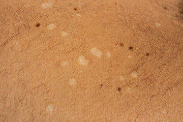 Skin Condition: Tinea Versicolor. Lack of pigmentation