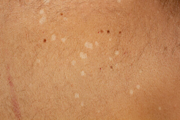 Skin Condition: Tinea Versicolor. Lack of pigmentation
