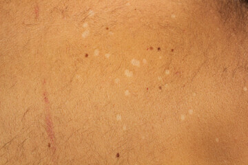 Skin Condition: Tinea Versicolor. Lack of pigmentation
