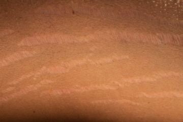 Male Body: Stretch Marks and Weight Changes
