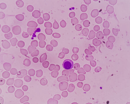 Blood smear show anisocytosis and target cells, Macrocytic anemia.