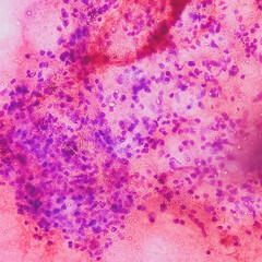 Cytological study of Abdominal mass: Spindle cell neoplasm, smear show cellular material of oval to...