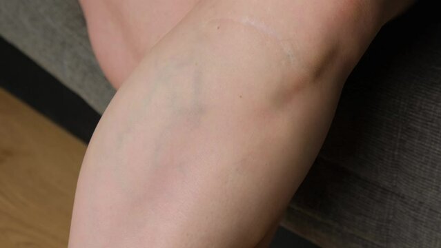 Scar on a girl's leg close-up. Varicose veins from the injury on the leg