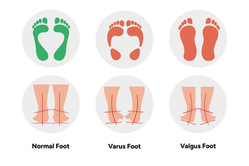 Normal, vatus and valgus Foot deformation 