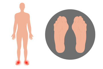 Foot deformation in human