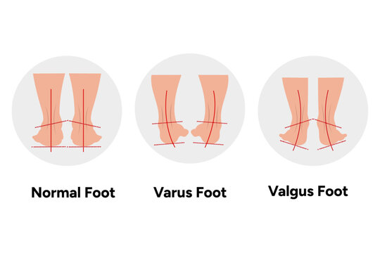Normal, varus and valgus Foot deformation 
