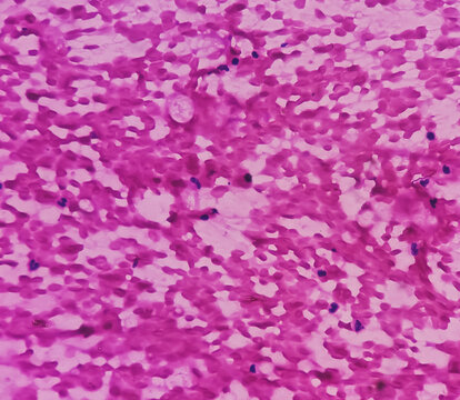 FNA from paravertebral mass. Suppurative inflammation. Smear show plenty of degenerated and intact polymorphs, lymphocytes and histiocytes.