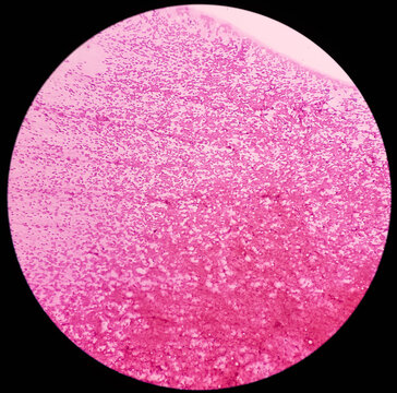 FNA from paravertebral mass. Suppurative inflammation. Smear show plenty of degenerated and intact polymorphs, lymphocytes and histiocytes.