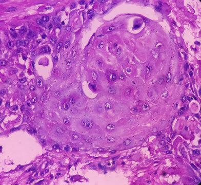 Nipple (biopsy): Invasive squamous cell carcinoma of nipple. microscopic image show malignant neoplasm. Male nipple cancer. Paget's disease of the nipple.