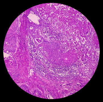 Nipple (biopsy): Invasive squamous cell carcinoma of nipple. microscopic image show malignant neoplasm. Male nipple cancer. Paget's disease of the nipple.