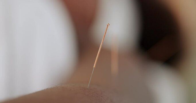 Person, closeup and body with acupuncture needle for tension, alternative medicine and healthcare. Skin, patient and client with muscle healing for pain, stress relief and holistic treatment