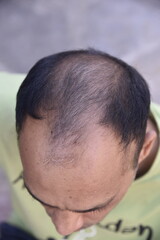Hair loss problem - 778661319