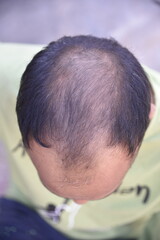 Hair loss problem - 778661321