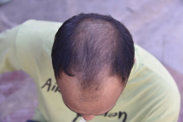 Hair loss problem - 778661339