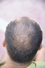 Hair loss problem - 778661349