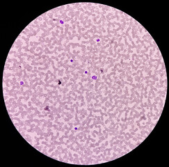 A peripheral blood smear, hypersegmented neutrophil was seen. Greater then 6 lobes in neutrophils. Megaloblastic anemia.