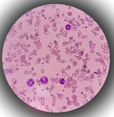 Acute leukemia, ALL(Acute lymphoblastic leukemia), peripheral blood smear. abnormal hematological...