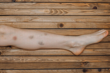 Trauma, bruises, hematomas on a girl's child's leg after sports. Concept of violence, beating a...