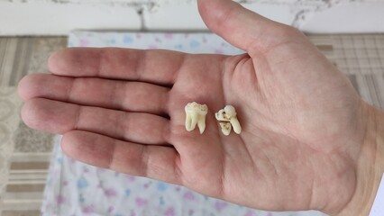 Dentist shows a removed tooth on his palm