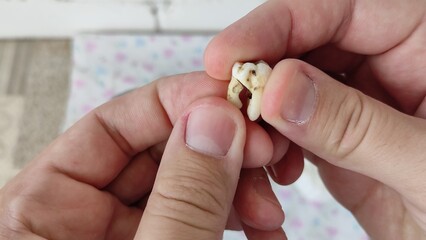 Dentist shows the removed and sawn tooth molar. Complicated tooth extraction. Close-up video