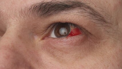 a human eye with a burst vessel and blood leaking into the eyeball, hemorrhage, a close view of a man's face
