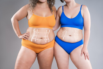 Two overweight women with cellulitis, fat flabby bellies, legs, hands, hips and buttocks on gray background, obese female body, liposuction and plastic surgery concept - 779509955