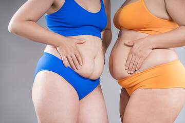 Tummy tuck, two fat women with cellulitis and flabby bellies on gray background, obese female body, plastic surgery and liposuction concept - 779510116